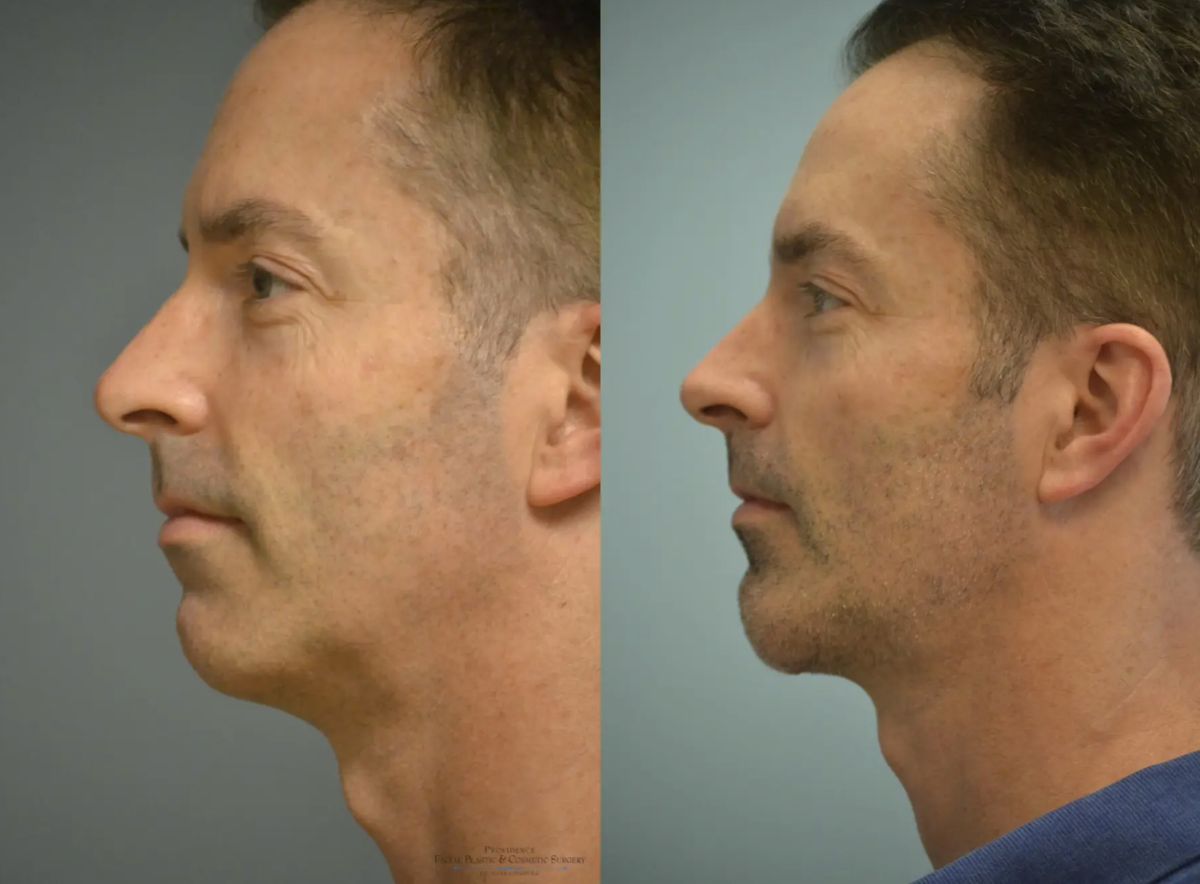 Chin Implant Before and After Pictures Philadelphia, PA