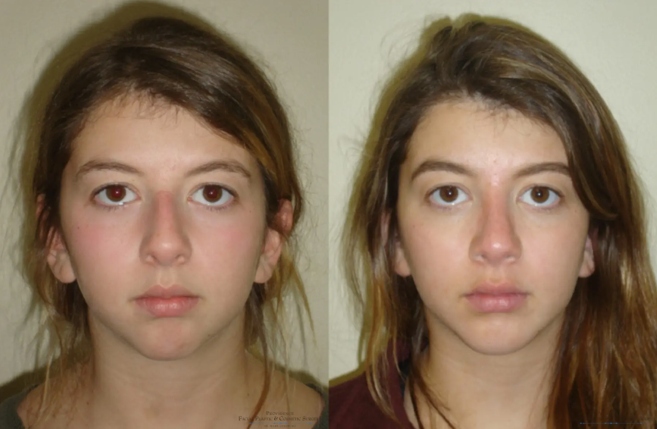 Chin Implant Before and After Pictures Philadelphia, PA