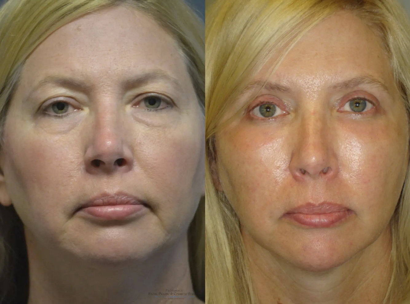 Eyelid Surgery Before and After Pictures Philadelphia, PA