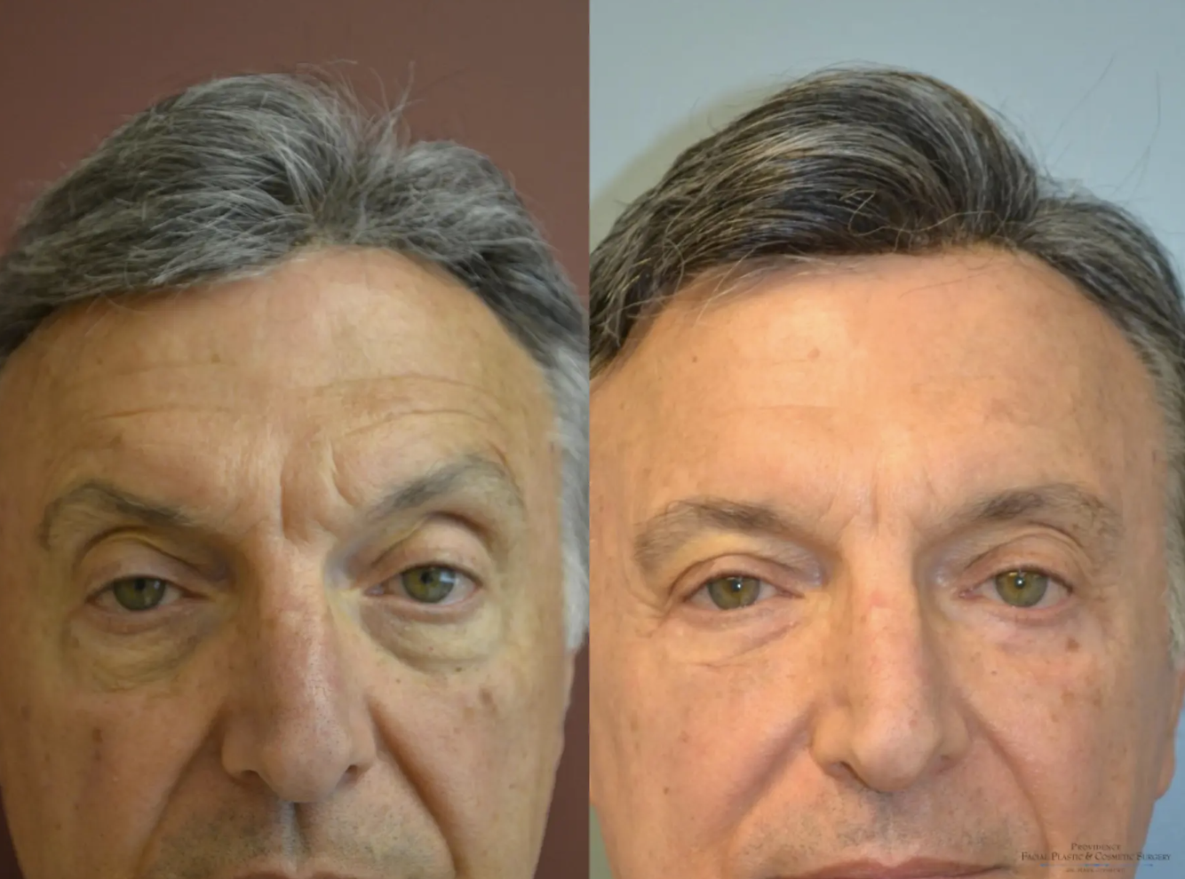 Eyelid Surgery Before and After Pictures Philadelphia, PA