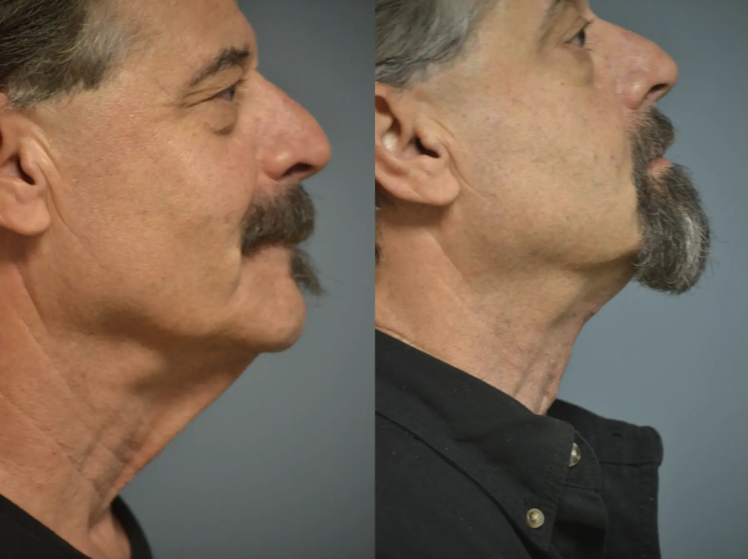 Neck Lift