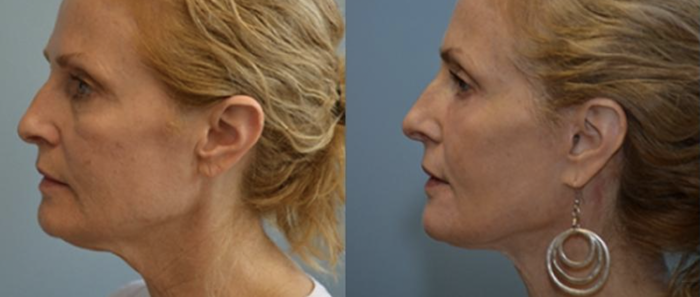 Facelift Before and After